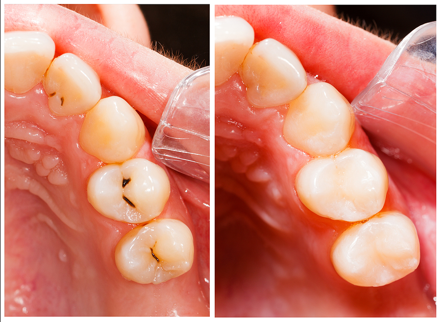 The Importance of Dental Fillings in Spring, TX: Restoring Your Smile and Oral Health
