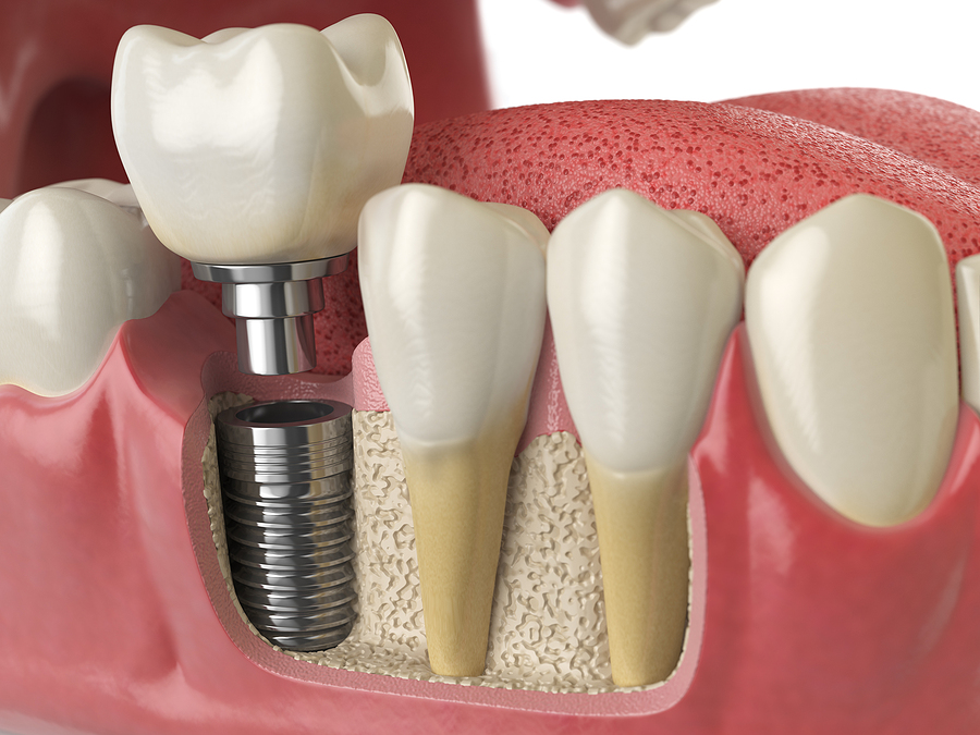 Restore Your Smile with Permanent Dental Implants In Spring, TX