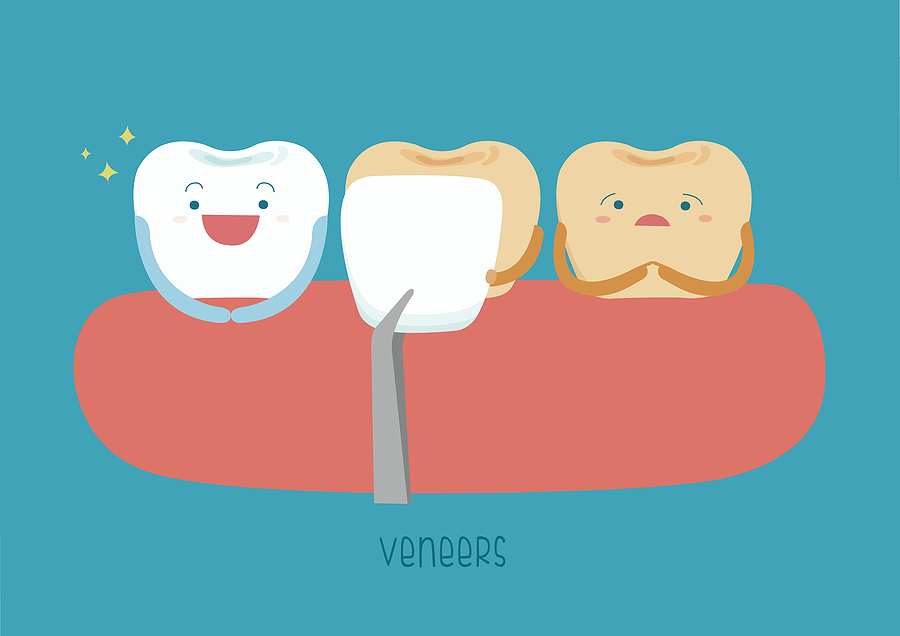 Transform Your Smile with Dental Veneers in Spring, TX