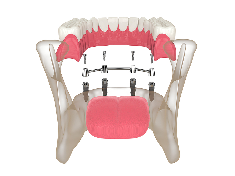 Implant-Supported Dentures: A Secure Solution for Missing Teeth