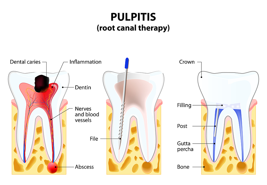 Understanding Root Canal Therapy in Spring, TX: Procedure, Benefits, and Recovery