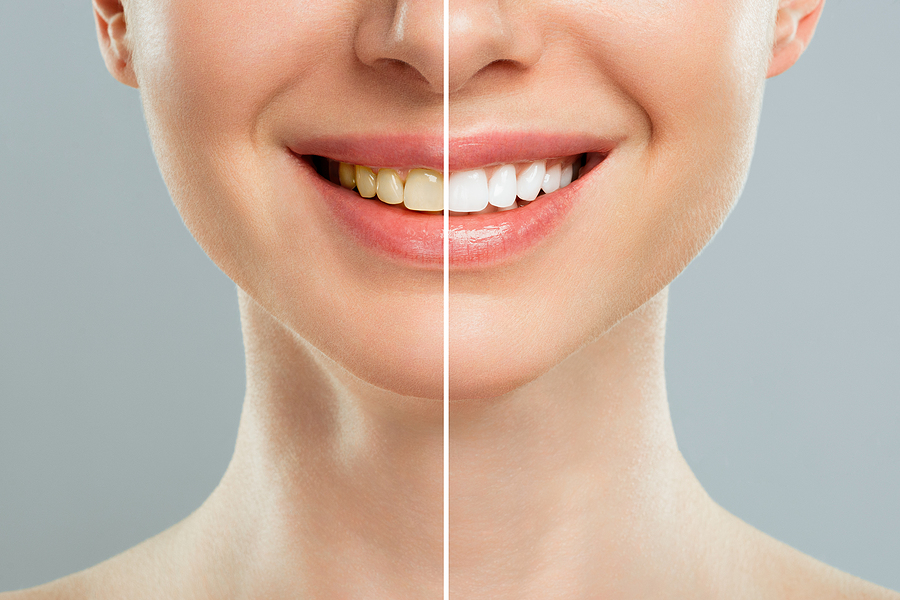 Achieve a Brighter Smile with Professional Teeth Whitening in Spring, TX