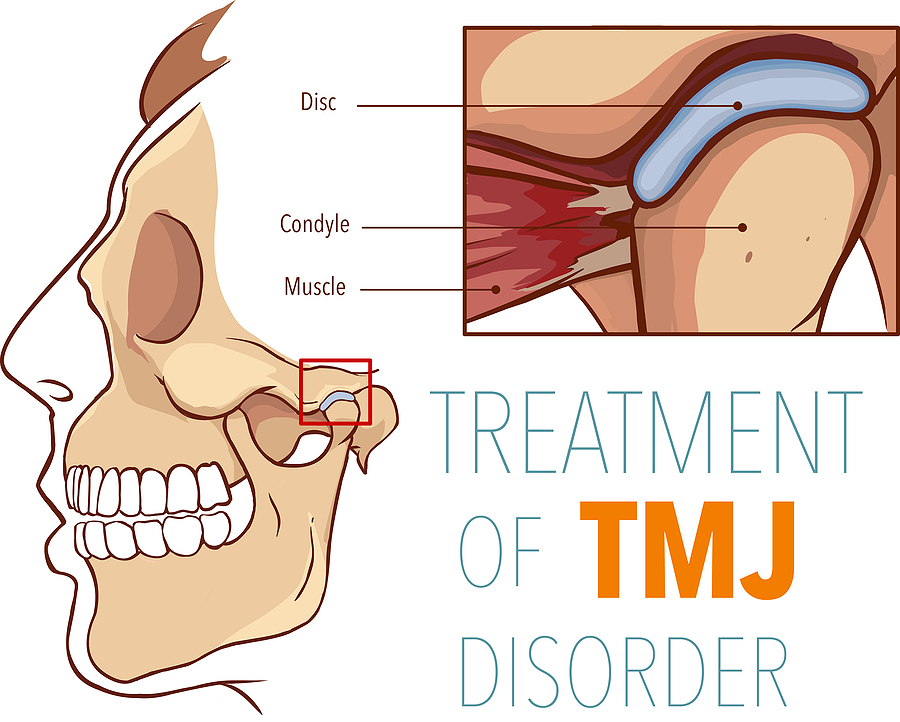 Relieving Jaw Pain: A Comprehensive Guide to TMJ Treatment